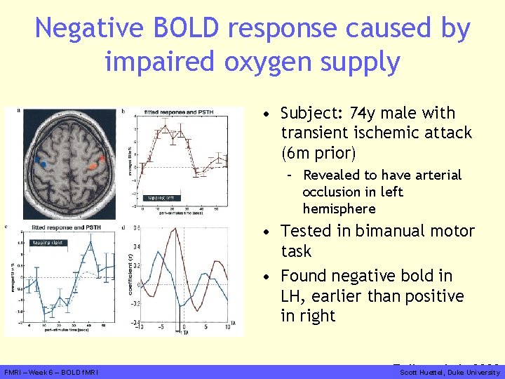 Negative BOLD response caused by impaired oxygen supply • Subject: 74 y male with