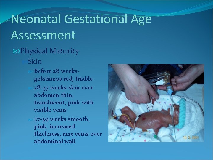 Neonatal Gestational Age Assessment Physical Maturity Skin Before 28 weeksgelatinous red, friable 28 -37 Neonatal Gestational Age Assessment Physical Maturity Skin Before 28 weeksgelatinous red, friable 28 -37