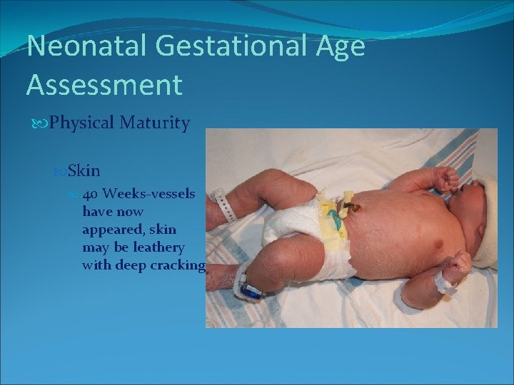 Neonatal Gestational Age Assessment Physical Maturity Skin 40 Weeks-vessels have now appeared, skin may Neonatal Gestational Age Assessment Physical Maturity Skin 40 Weeks-vessels have now appeared, skin may