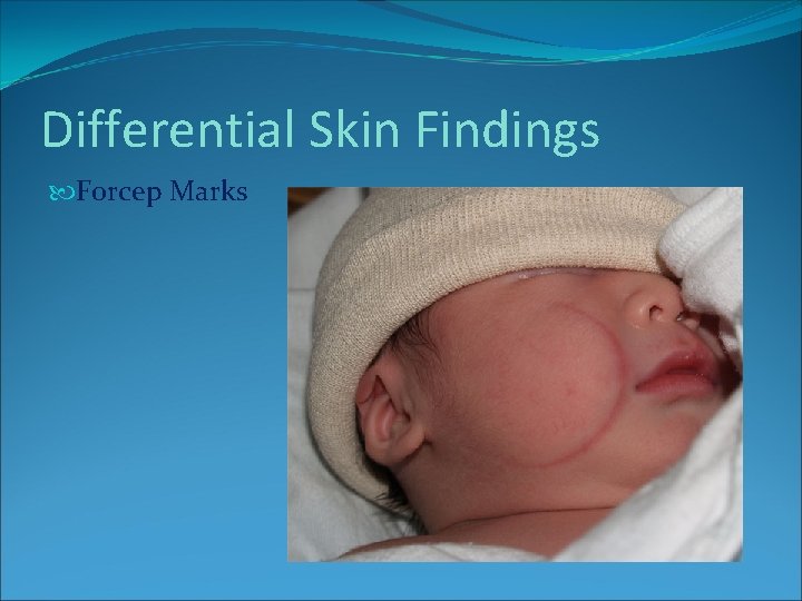 Differential Skin Findings Forcep Marks Differential Skin Findings Forcep Marks