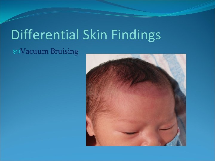 Differential Skin Findings Vacuum Bruising Differential Skin Findings Vacuum Bruising