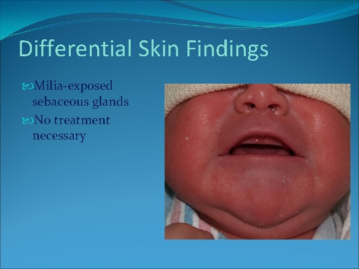 Differential Skin Findings Milia-exposed sebaceous glands No treatment necessary Differential Skin Findings Milia-exposed sebaceous glands No treatment necessary
