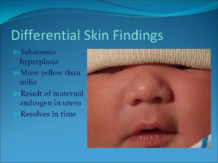 Differential Skin Findings Sebaceous hyperplasia More yellow than milia Result of maternal androgen in Differential Skin Findings Sebaceous hyperplasia More yellow than milia Result of maternal androgen in