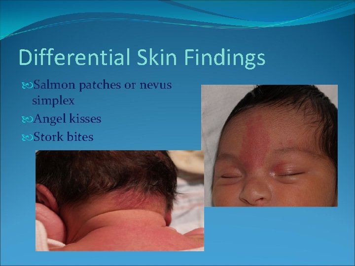 Differential Skin Findings Salmon patches or nevus simplex Angel kisses Stork bites Differential Skin Findings Salmon patches or nevus simplex Angel kisses Stork bites