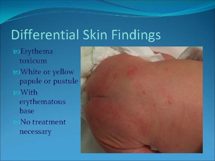 Differential Skin Findings Erythema toxicum White or yellow papule or pustule With erythematous base Differential Skin Findings Erythema toxicum White or yellow papule or pustule With erythematous base