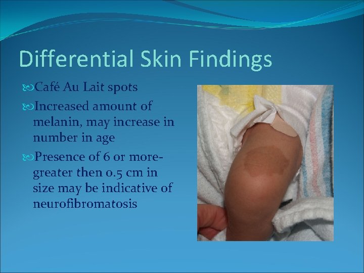 Differential Skin Findings Café Au Lait spots Increased amount of melanin, may increase in Differential Skin Findings Café Au Lait spots Increased amount of melanin, may increase in