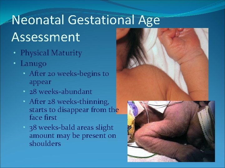 Neonatal Gestational Age Assessment • Physical Maturity • Lanugo • After 20 weeks-begins to Neonatal Gestational Age Assessment • Physical Maturity • Lanugo • After 20 weeks-begins to
