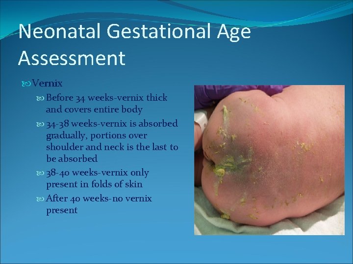 Neonatal Gestational Age Assessment Vernix Before 34 weeks-vernix thick and covers entire body 34 Neonatal Gestational Age Assessment Vernix Before 34 weeks-vernix thick and covers entire body 34