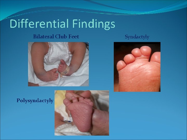 Differential Findings Bilateral Club Feet Polysyndactyly Syndactyly Differential Findings Bilateral Club Feet Polysyndactyly Syndactyly