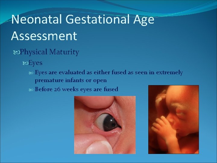 Neonatal Gestational Age Assessment Physical Maturity Eyes are evaluated as either fused as seen Neonatal Gestational Age Assessment Physical Maturity Eyes are evaluated as either fused as seen