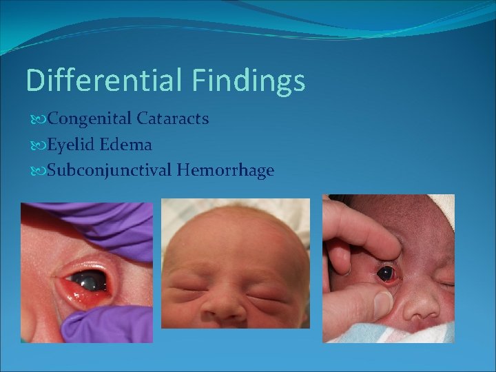 Differential Findings Congenital Cataracts Eyelid Edema Subconjunctival Hemorrhage Differential Findings Congenital Cataracts Eyelid Edema Subconjunctival Hemorrhage