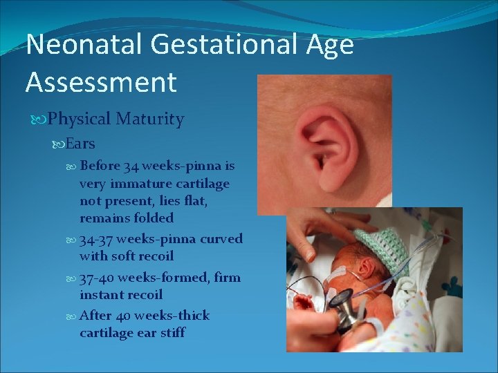 Neonatal Gestational Age Assessment Physical Maturity Ears Before 34 weeks-pinna is very immature cartilage Neonatal Gestational Age Assessment Physical Maturity Ears Before 34 weeks-pinna is very immature cartilage