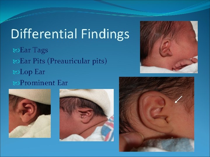 Differential Findings Ear Tags Ear Pits (Preauricular pits) Lop Ear Prominent Ear Differential Findings Ear Tags Ear Pits (Preauricular pits) Lop Ear Prominent Ear