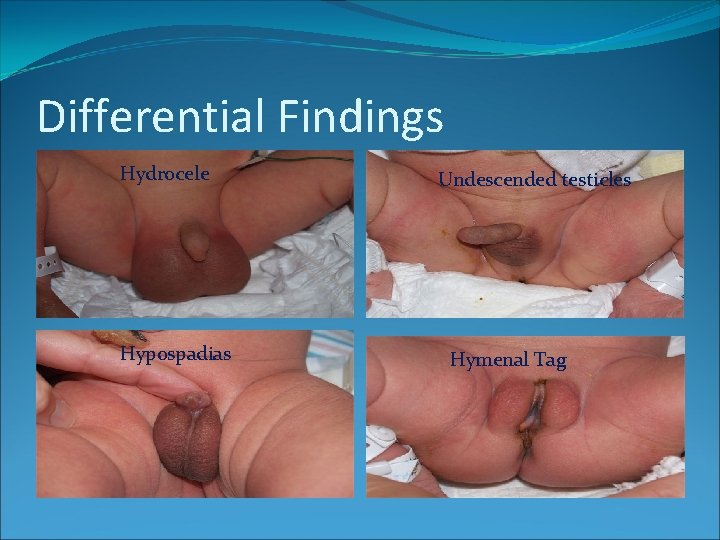 Differential Findings Hydrocele Hypospadias Undescended testicles Hymenal Tag Differential Findings Hydrocele Hypospadias Undescended testicles Hymenal Tag