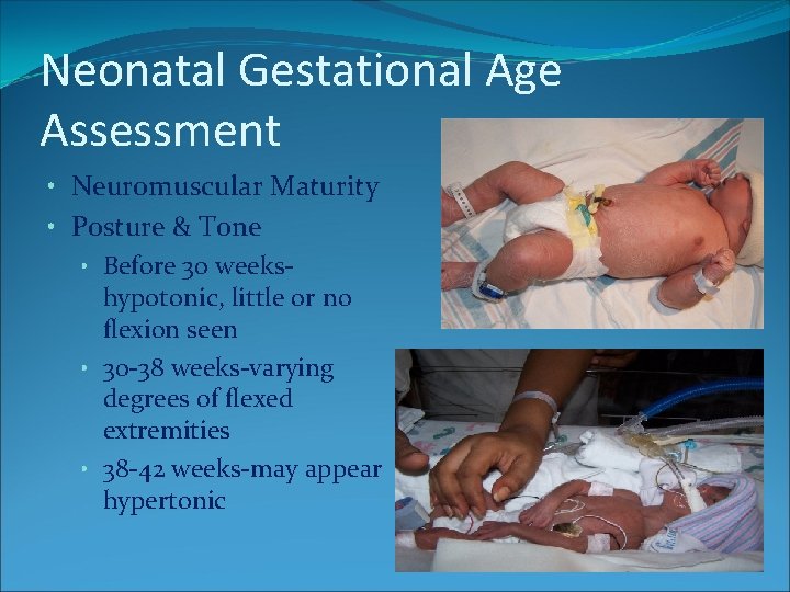 Neonatal Gestational Age Assessment • Neuromuscular Maturity • Posture & Tone • Before 30 Neonatal Gestational Age Assessment • Neuromuscular Maturity • Posture & Tone • Before 30