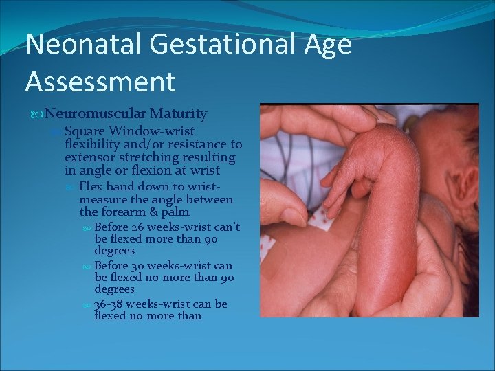Neonatal Gestational Age Assessment Neuromuscular Maturity Square Window-wrist flexibility and/or resistance to extensor stretching Neonatal Gestational Age Assessment Neuromuscular Maturity Square Window-wrist flexibility and/or resistance to extensor stretching