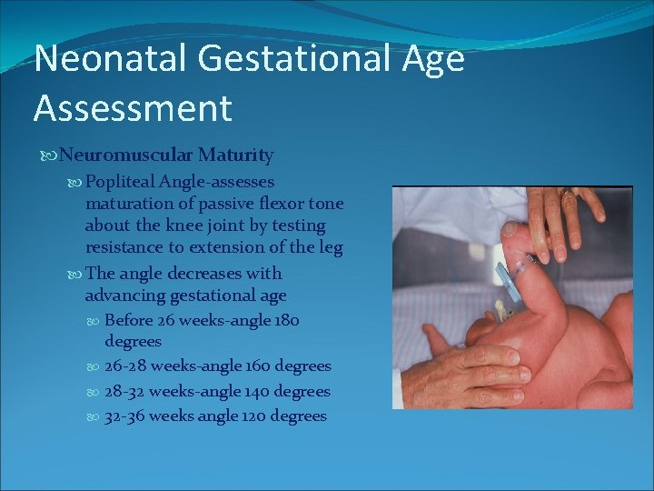 Neonatal Gestational Age Assessment Neuromuscular Maturity Popliteal Angle-assesses maturation of passive flexor tone about Neonatal Gestational Age Assessment Neuromuscular Maturity Popliteal Angle-assesses maturation of passive flexor tone about