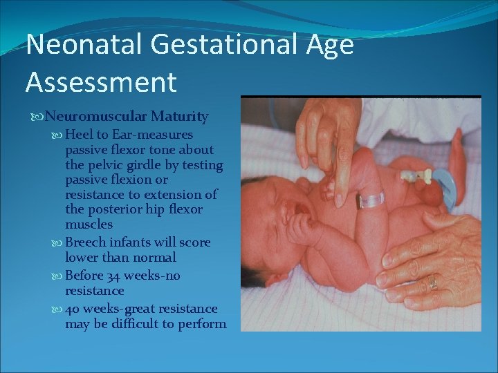 Neonatal Gestational Age Assessment Neuromuscular Maturity Heel to Ear-measures passive flexor tone about the Neonatal Gestational Age Assessment Neuromuscular Maturity Heel to Ear-measures passive flexor tone about the