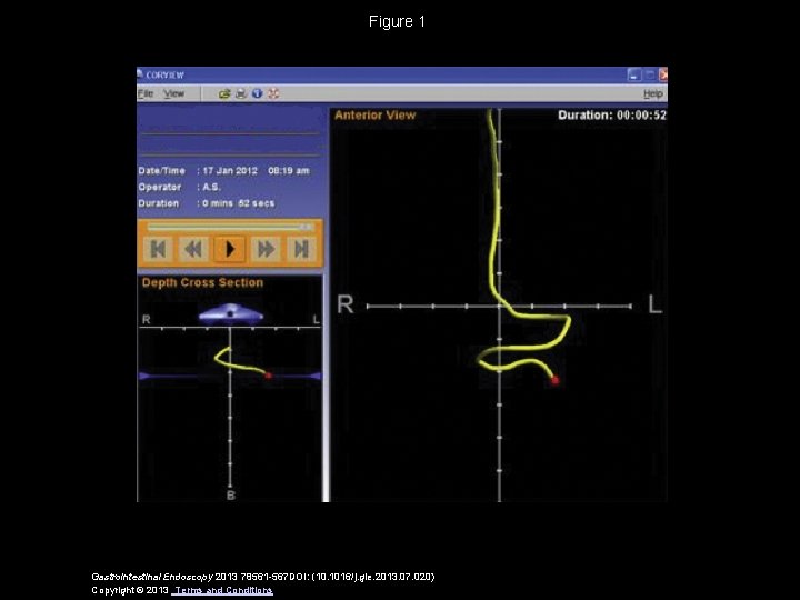 Figure 1 Gastrointestinal Endoscopy 2013 78561 -567 DOI: (10. 1016/j. gie. 2013. 07. 020)