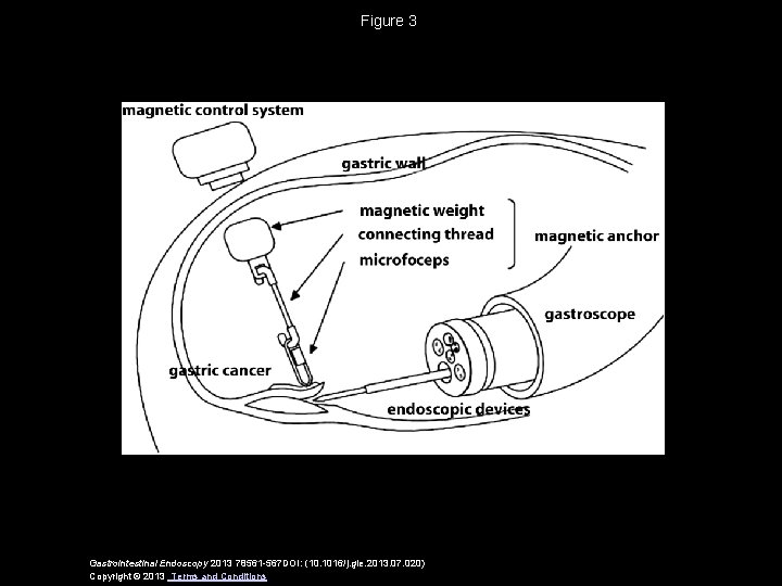 Figure 3 Gastrointestinal Endoscopy 2013 78561 -567 DOI: (10. 1016/j. gie. 2013. 07. 020)