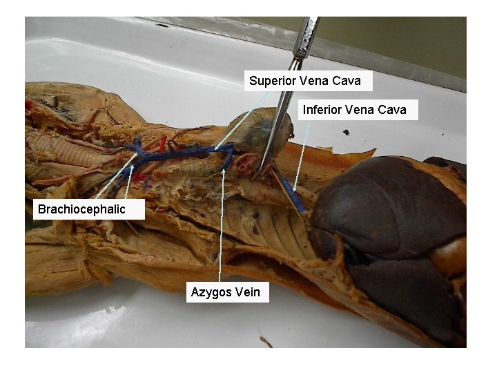 Superior Vena Cava Inferior Vena Cava Brachiocephalic Azygos Vein 