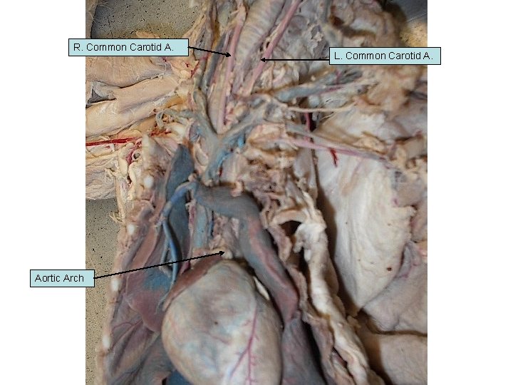 R. Common Carotid A. Aortic Arch L. Common Carotid A. 