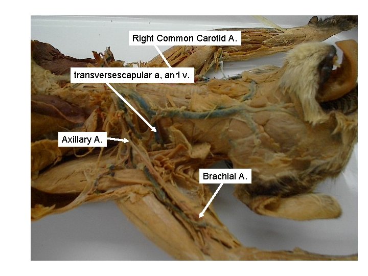 Right Common Carotid A. transversescapular a, and v. Axillary A. Brachial A. Right Common Carotid A. transversescapular a, and v. Axillary A. Brachial A.