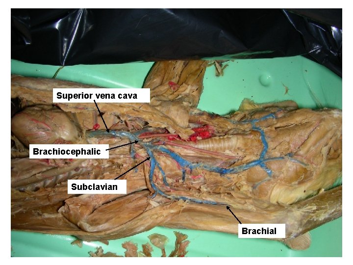 Superior vena cava Brachiocephalic Subclavian Brachial 