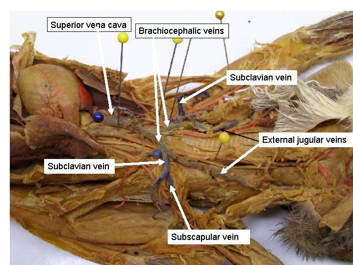 Superior vena cava Brachiocephalic veins Subclavian vein External jugular veins Subclavian vein Subscapular vein Superior vena cava Brachiocephalic veins Subclavian vein External jugular veins Subclavian vein Subscapular vein