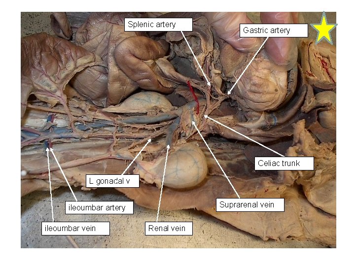 Splenic artery Gastric artery Celiac trunk L gonadal v Suprarenal vein ileoumbar artery ileoumbar Splenic artery Gastric artery Celiac trunk L gonadal v Suprarenal vein ileoumbar artery ileoumbar
