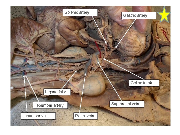 Splenic artery Gastric artery Celiac trunk L gonadal v Suprarenal vein ileoumbar artery ileoumbar