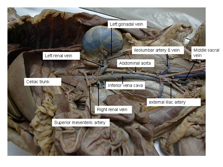 Left gonadal vein ileolumbar artery & vein Left renal vein Abdominal aorta Celiac trunk