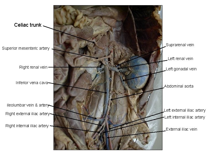 Celiac trunk Superior mesenteric artery Suprarenal vein Left renal vein Right renal vein Inferior