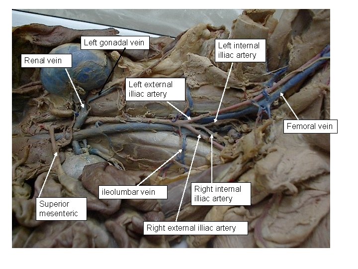 Left gonadal vein Left internal illiac artery Renal vein Left external illiac artery Femoral Left gonadal vein Left internal illiac artery Renal vein Left external illiac artery Femoral
