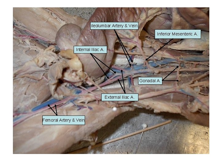 ileolumbar Artery & Vein Inferior Mesenteric A. Internal Iliac A. Gonadal A. External Iliac ileolumbar Artery & Vein Inferior Mesenteric A. Internal Iliac A. Gonadal A. External Iliac