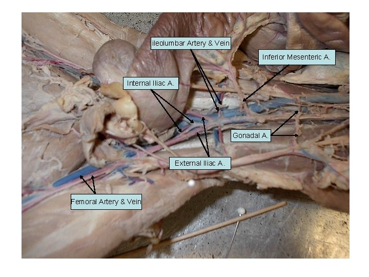 ileolumbar Artery & Vein Inferior Mesenteric A. Internal Iliac A. Gonadal A. External Iliac