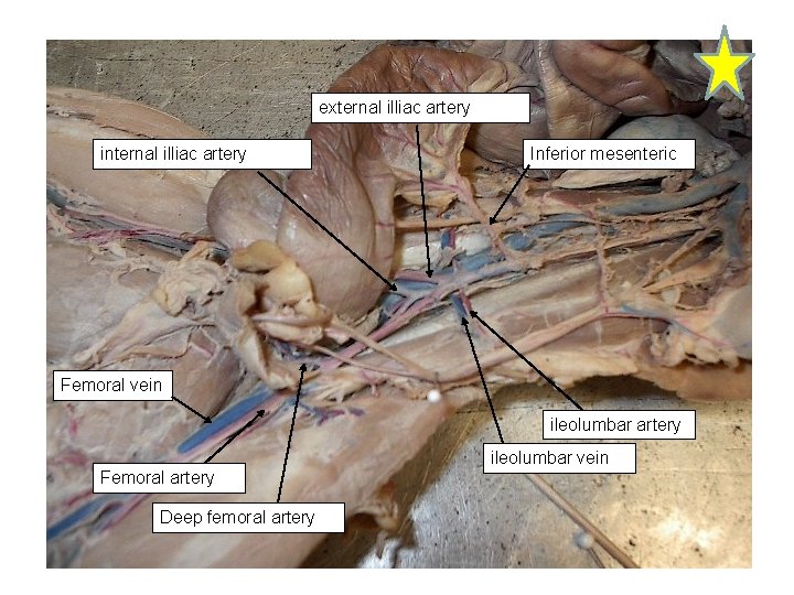 external illiac artery internal illiac artery Inferior mesenteric Femoral vein ileolumbar artery ileolumbar vein