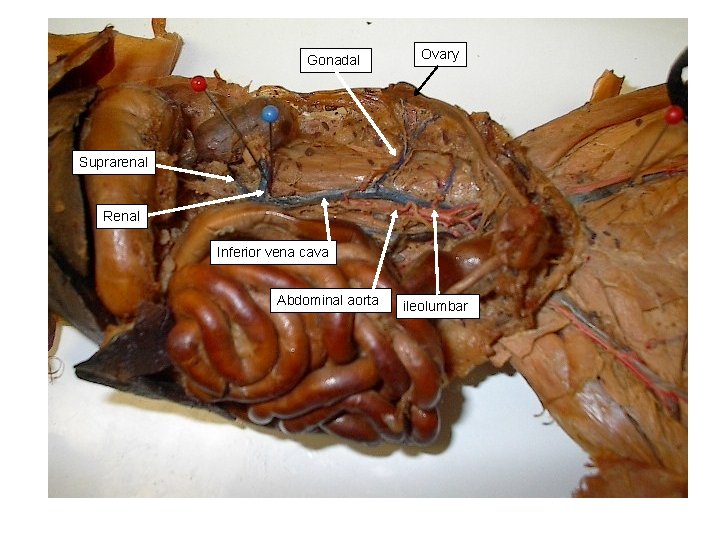 Gonadal Ovary Suprarenal Renal Inferior vena cava Abdominal aorta ileolumbar 