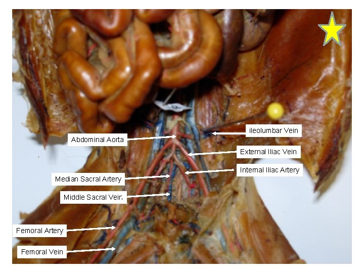 ileolumbar Vein Abdominal Aorta External Iliac Vein Internal Iliac Artery Median Sacral Artery Middle ileolumbar Vein Abdominal Aorta External Iliac Vein Internal Iliac Artery Median Sacral Artery Middle