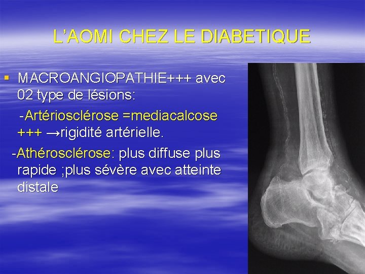 L’AOMI CHEZ LE DIABETIQUE § MACROANGIOPATHIE+++ avec 02 type de lésions: -Artériosclérose =mediacalcose +++