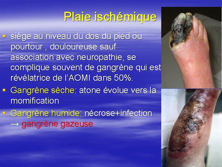 Plaie ischémique § siège au niveau du dos du pied ou pourtour , douloureuse