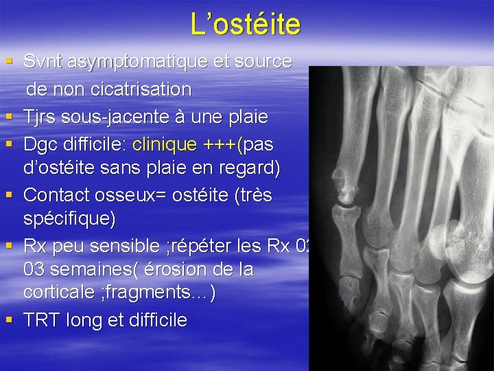 L’ostéite § Svnt asymptomatique et source de non cicatrisation § Tjrs sous-jacente à une