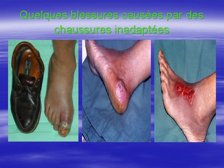 Quelques blessures causées par des chaussures inadaptées 