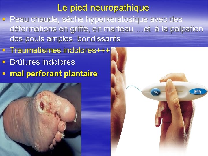 Le pied neuropathique § Peau chaude, sèche hyperkeratosique avec des déformations en griffe, en