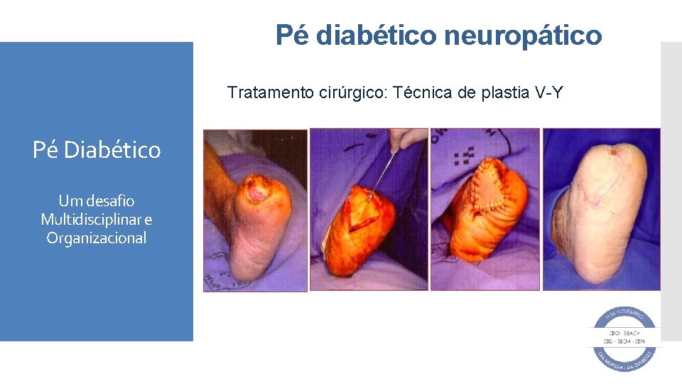 Pé diabético neuropático Tratamento cirúrgico: Técnica de plastia V-Y Pé Diabético Um desafio Multidisciplinar