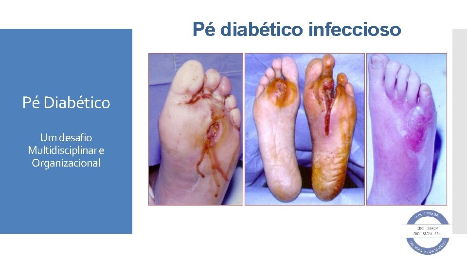 Pé diabético infeccioso Pé Diabético Um desafio Multidisciplinar e Organizacional 