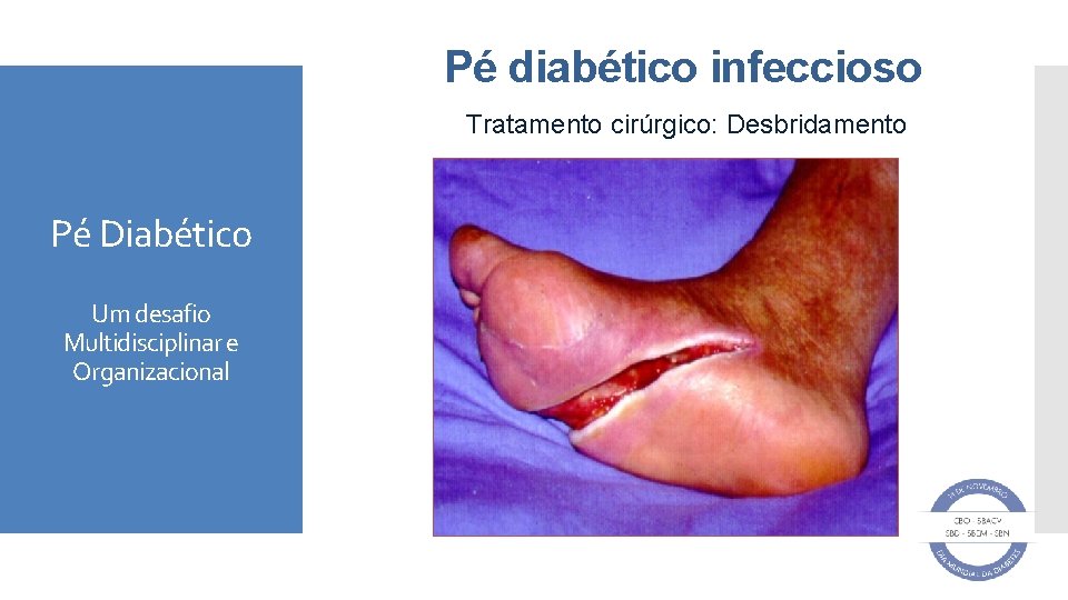 Pé diabético infeccioso Tratamento cirúrgico: Desbridamento Pé Diabético Um desafio Multidisciplinar e Organizacional 