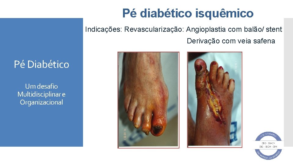 Pé diabético isquêmico Indicações: Revascularização: Angioplastia com balão/ stent Derivação com veia safena Pé