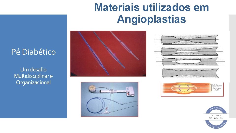 Materiais utilizados em Angioplastias Pé Diabético Um desafio Multidisciplinar e Organizacional 