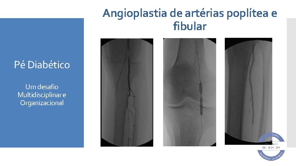 Angioplastia de artérias poplítea e fibular Pé Diabético Um desafio Multidisciplinar e Organizacional 